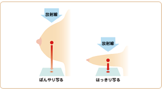 乳房を平たく伸ばすことで放射線から守り、より良い撮影ができます。